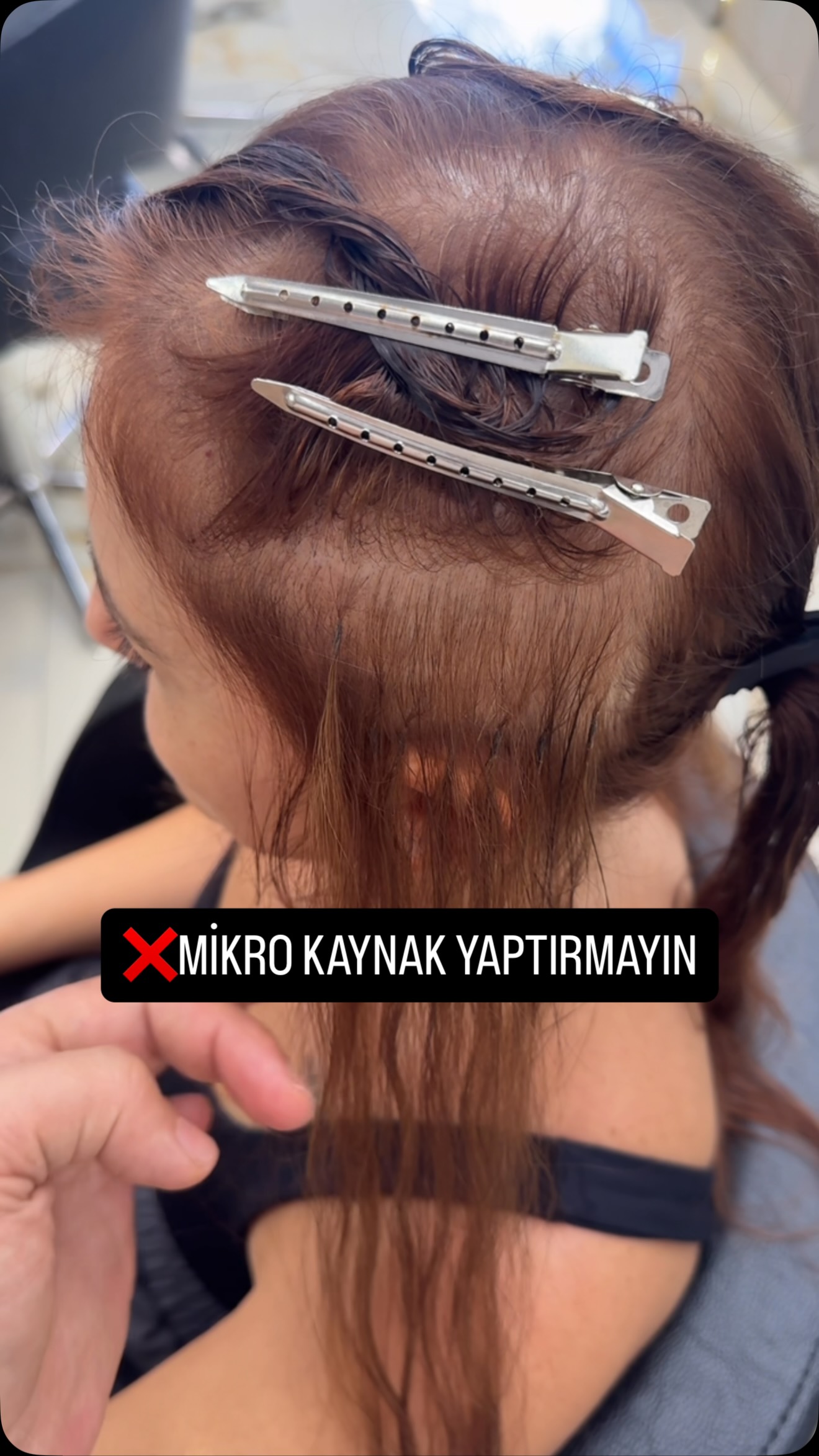 FULL %100 MEDİKAL KAYNAK UYGULANMIŞTIR✅
#medikalkaynak #mikrokaynak #bostanlı #izmir